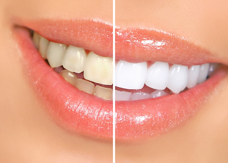Teeth Whitening  Hacienda Heights, CA 